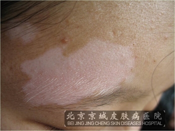 治疗白癜风较好的医院是哪家?