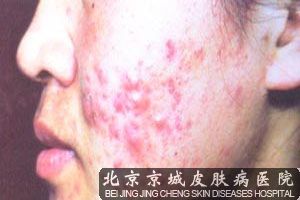 什么是痤疮杆菌有何症状特点