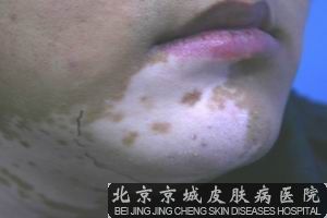 白癜风能吗