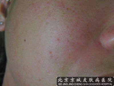 脂溢性皮炎症状都有哪些