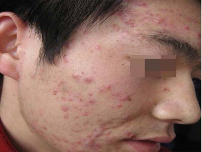 痤疮是怎么引起的